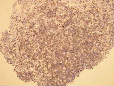 Immunohistochemistry-Paraffin: Bcl-2 Antibody (P21-A) [NBP1-79011] -  Expression in extranodal marginal zone lymphoma of mucosa - associated lymhoid tissue (MALT lymphoma) of the stomach.