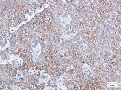 Immunohistochemistry-Paraffin: Bcl-2 Antibody (S07-2A1) [NBP3-14876] - Immunohistochemistry of Bcl-2 in paraffin-embedded Human breast cancer tissue using Bcl-2 Rabbit mAb at dilution 1/1