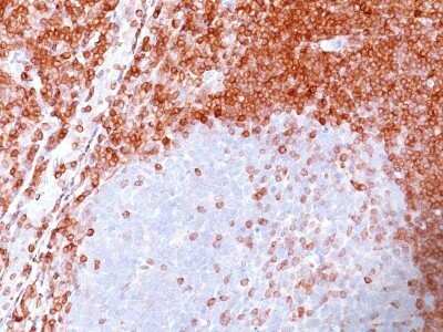 Immunohistochemistry-Paraffin: Bcl-2 Antibody (SPM117) - Azide and BSA Free [NBP2-34440] - Formalin-paraffin non-Hodgkin's lymphoma stained with Bcl-2 Ab (SPM117). Note nuclear membrane & cytoplasmic staining.