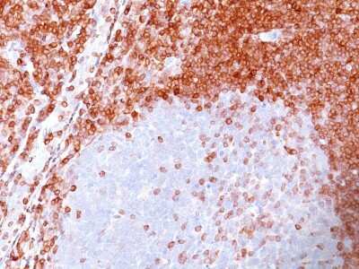 Immunohistochemistry-Paraffin: Bcl-2 Antibody (SPM117) [NBP2-34391] - Formalin-paraffin non-Hodgkin's lymphomastained with Bcl-2 Ab (SPM117). Note nuclear membrane & cytoplasmic staining.