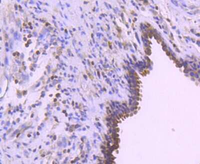 Immunohistochemistry-Paraffin: Bcl-2 Antibody (SZ10-03) [NBP2-67351] - Analysis of paraffin-embedded human breast carcinoma tissue using anti-Bcl-2 antibody. Counter stained with hematoxylin.