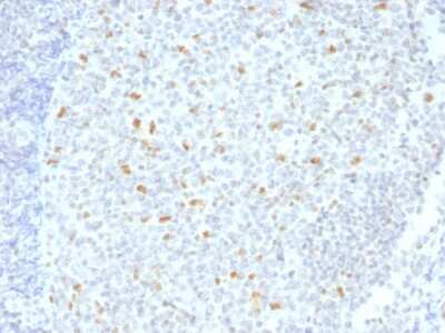 Immunohistochemistry-Paraffin: Bcl-6 Antibody (BCL6/1526) [NBP3-08852] - Formalin-fixed, paraffin-embedded human Hodgkin's Lymphoma stained with Bcl-6 Mouse Monoclonal Antibody (BCL6/1526).