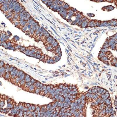 Immunohistochemistry-Paraffin: Bcl G Antibody (6R9F3) [NBP3-15746] - Immunohistochemistry of paraffin-embedded human colon carcinoma using BCL2L14/Bcl G Rabbit mAb (NBP3-15746) at dilution of 1:100 (40x lens).Perform microwave antigen retrieval with 10 mM Tris/EDTA buffer pH 9.0 before commencing with IHC staining protocol.