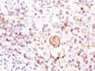 Immunohistochemistry-Paraffin: bcl-x Antibody (BX006) - Azide and BSA Free [NBP2-33164] - Formalin-paraffin Hodgkin's lymphoma stained with bcl-x antibody (BX006). Note cytoplasmic and membrane staining.