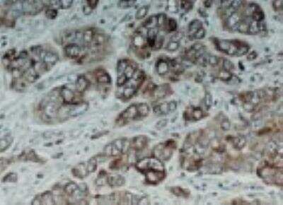 Immunohistochemistry-Paraffin: Bcl-xL Antibody [NB100-56103] - FFPE human colon carcinoma tissue section stained for Bcl-X expression using this antibody at 1:2000. Hematoxylin-eosin counterstain.