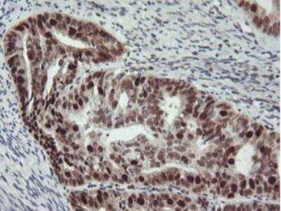 Immunohistochemistry-Paraffin: Bcl-xL Antibody (OTI4A9) - Azide and BSA Free [NBP2-70247] - Staining of paraffin-embedded Adenocarcinoma of Human endometrium tissue using anti-BCL-XL mouse monoclonal antibody (1:150).