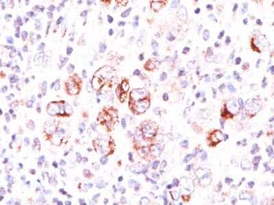 Immunohistochemistry-Paraffin: bcl-x Antibody (SPM165) - Azide and BSA Free [NBP2-34743] - Formalin-paraffin Hodgkin's lymphoma stained with bcl-x monoclonal antibody (SPM165). Note cytoplasmic and membrane staining.