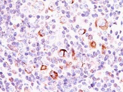 Immunohistochemistry-Paraffin: bcl-x Antibody (SPM337) - Azide and BSA Free [NBP2-47814] - Human Hodgkin's Lymphoma stained with bcl-x Monoclonal Antibody (SPM337).