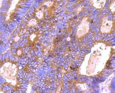 Immunohistochemistry-Paraffin: Bcl-xL Antibody (SZ3-03) [NBP2-67363] - Analysis of paraffin-embedded human colon cancer tissue using anti-Bcl-XL antibody. Counter stained with hematoxylin.
