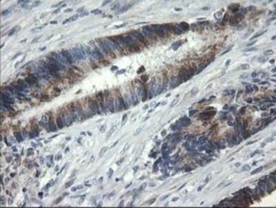Immunohistochemistry: Beta-1,3-N-Acetylglucosaminyltransferase 2/B3GNT2 Antibody (OTI3A9) - Azide and BSA Free [NBP2-71624] - Analysis of Adenocarcinoma of Human colon tissue. (Heat-induced epitope retrieval by 10mM citric buffer, pH6.0, 120C for 3min)