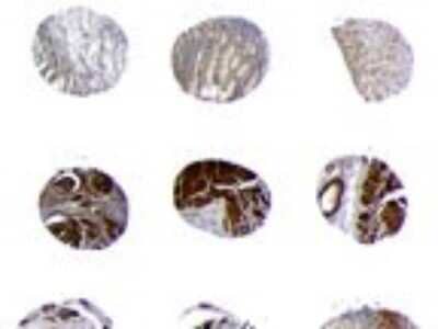 Immunohistochemistry-Paraffin: Bid Antibody [NB100-56107] - Six representative cores from a human gastric carcinoma formalin-fixed, paraffin-embedded tissue microarray stained for Bid expression using this antibody at 1:2000. Hematoxylin-eosin counterstain.