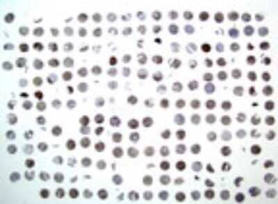 Immunohistochemistry-Paraffin: Bid Antibody [NB100-56107] - Formalin-fixed, paraffin-embedded human gastric carcinoma tissue array stained for Bid expression using this antibody at 1:2000. Hematoxylin-eosin counterstain. Variable Bid expression is seen between patient samples.