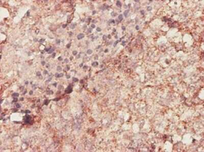 Immunohistochemistry-Paraffin: Biglycan Antibody (4E1-1G7) [H00000633-M01] - Analysis of monoclonal antibody to BGN on formalin-fixed paraffin-embedded human lung, adenosquamous cell carcinoma. Antibody concentration 1 ~ 10 ug/ml.