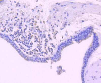 Immunohistochemistry-Paraffin: Bim Antibody (SU0318) [NBP2-67456] - Analysis of paraffin-embedded human breast carcinoma tissue using anti-Bim antibody. Counter stained with hematoxylin.