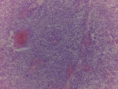 Hematoxylin & Eosin Stain: Bladder Tissue Slides (Tumor) [NBP2-77631] - Tissue: Bladder, Human, Tumorous