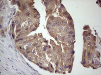 Immunohistochemistry: Bmf Antibody (OTI6F3) - Azide and BSA Free [NBP2-72311] - Analysis of Adenocarcinoma of Human breast tissue. (Heat-induced epitope retrieval by 1 mM EDTA in 10mM Tris, pH8.5, 120C for 3min).