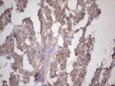 Immunohistochemistry: Bmf Antibody (OTI6F3) - Azide and BSA Free [NBP2-72311] - Analysis of Adenocarcinoma of Human endometrium tissue. (Heat-induced epitope retrieval by 1 mM EDTA in 10mM Tris, pH8.5, 120C for 3min)
