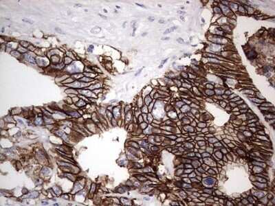 Immunohistochemistry: Boll Antibody (OTI2D11) - Azide and BSA Free [NBP2-72180] - Analysis of Adenocarcinoma of Human colon tissue. (Heat-induced epitope retrieval by 1 mM EDTA in 10mM Tris, pH8.5, 120C for 3min)