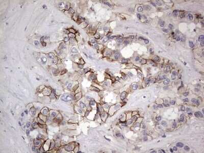 Immunohistochemistry: Boll Antibody (OTI2D11) - Azide and BSA Free [NBP2-72180] - Analysis of Carcinoma of Human liver tissue.(Heat-induced epitope retrieval by 1 mM EDTA in 10mM Tris, pH8.5, 120C for 3min)