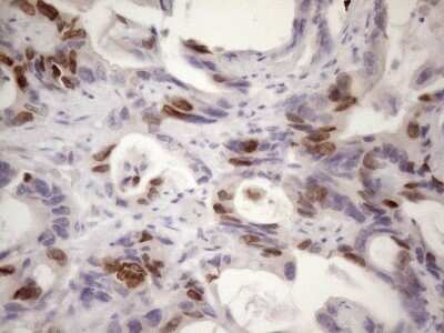 Immunohistochemistry: Borealin Antibody (OTI4G3) - Azide and BSA Free [NBP2-71988] - Analysis of Adenocarcinoma of Human colon tissue. (Heat-induced epitope retrieval by 1mM EDTA in 10mM Tris buffer (pH8.5) at 120C for 3 min)