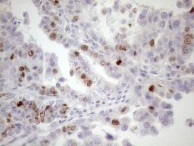 Immunohistochemistry: Borealin Antibody (OTI4G3) - Azide and BSA Free [NBP2-71988] - Analysis of Adenocarcinoma of Human ovary tissue. (Heat-induced epitope retrieval by 1mM EDTA in 10mM Tris buffer (pH8.5) at 120C for 3 min)