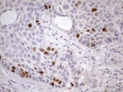 Immunohistochemistry: Borealin Antibody (OTI4G3) - Azide and BSA Free [NBP2-71988] - Analysis of Carcinoma of Human lung tissue.(Heat-induced epitope retrieval by 1mM EDTA in 10mM Tris buffer (pH8.5) at 120C for 3 min)