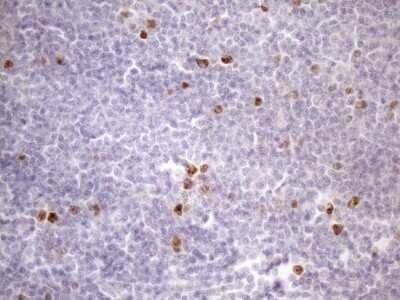 Immunohistochemistry: Borealin Antibody (OTI4G3) - Azide and BSA Free [NBP2-71988] - Analysis of Human lymphoma tissue. (Heat-induced epitope retrieval by 1mM EDTA in 10mM Tris buffer (pH8.5) at 120C for 3 min)