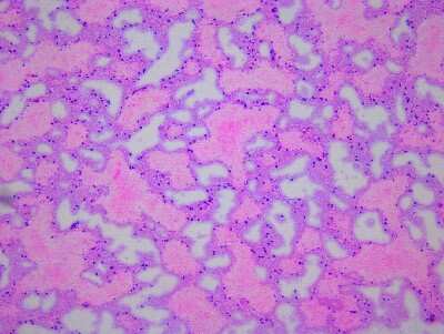 Hematoxylin & Eosin Stain: Brain Amygdala Tissue Slides (Parkinson's) [NBP2-77690] - Tissue: Human Brain (Amygdala),  Pathology: Parkinson's Disease
