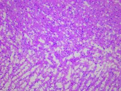 Hematoxylin & Eosin Stain: Brain Corpus Callosum Tissue Slides (Multiple Sclerosis) [NBP2-77678] - Tissue: Human Brain (Corpus Callosum),  Pathology: Multiple Sclerosis