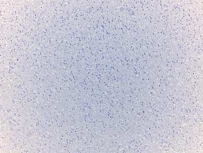 Hematoxylin & Eosin Stain: Brain Corpus Callosum Tissue Slides (Multiple Sclerosis) [NBP2-77987] - Tissue: Human Brain (Corpus Callosum),  Pathology: Multiple Sclerosis