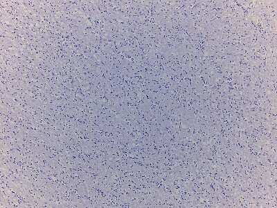 Hematoxylin & Eosin Stain: Brain Corpus Callosum Tissue Slides (Parkinson's) [NBP2-78000] - Tissue: Human Brain (Corpus Callosum),  Pathology: Parkinson's Disease