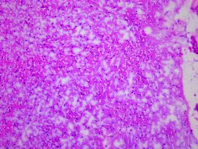 Hematoxylin & Eosin Stain: Brain Frontal Lobe Tissue Slides (Alzheimer's) [NBP2-77596] - Tissue: Brain (Frontal Lobe),  Pathology: Alzheimer's Disease