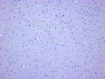 Hematoxylin & Eosin Stain: Brain Frontal Lobe Tissue Slides (Parkinson's) [NBP2-78001] - Tissue: Human Brain (Frontal Lobe),  Pathology: Parkinson's Disease