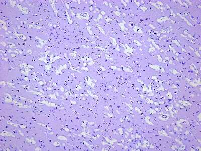 Hematoxylin & Eosin Stain: Brain Frontal Lobe Tissue Slides (Progressive Supranuclear Palsy) [NBP2-78011] - Tissue: Human Brain (Frontal Lobe),  Pathology: Progressive Supranuclear Palsy