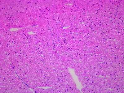 Hematoxylin & Eosin Stain: Brain Occipital Lobe Tissue Slides (Multiple Sclerosis) [NBP2-77682] - Tissue: Human Brain (Occipital Lobe),  Pathology: Multiple Sclerosis