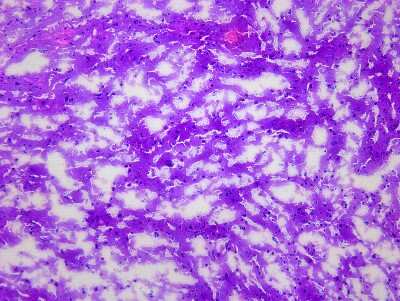 Hematoxylin & Eosin Stain: Brain Occipital Lobe Tissue Slides (Parkinson's) [NBP2-77694] - Tissue: Human Brain (Occipital Lobe),  Pathology: Parkinson's Disease