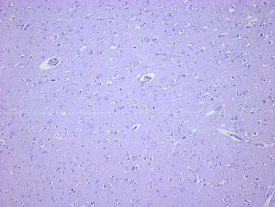 Hematoxylin & Eosin Stain: Brain Parietal Lobe Tissue Slides (Alzheimer's) [NBP2-77829] - Tissue: Human Brain (Parietal Lobe),  Pathology: Alzheimer's Disease