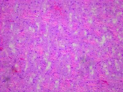 Hematoxylin & Eosin Stain: Brain Parietal Lobe Tissue Slides (Multiple Sclerosis) [NBP2-77683] - Tissue: Human Brain (Parietal Lobe),  Pathology: Multiple Sclerosis