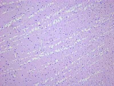 Hematoxylin & Eosin Stain: Brain Parietal Lobe Tissue Slides (Multiple Sclerosis) [NBP2-77992] - Tissue: Human Brain (Parietal Lobe),  Pathology: Multiple Sclerosis