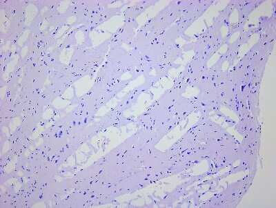 Hematoxylin & Eosin Stain: Brain Parietal Lobe Tissue Slides (Progressive Supranuclear Palsy) [NBP2-78014] - Tissue: Human Brain (Parietal Lobe),  Pathology: Progressive Supranuclear Palsy