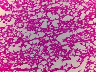 Hematoxylin & Eosin Stain: Brain Pons Tissue Slides (Alzheimer's) [NBP2-77604] - Tissue: Human Brain (Pons),  Pathology: Alzheimer's Disease