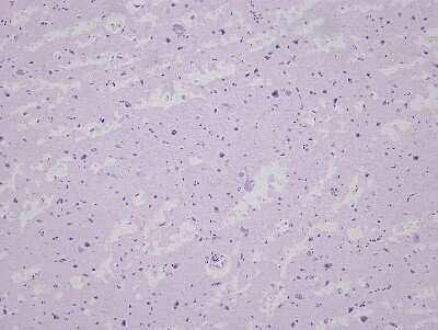 Hematoxylin & Eosin Stain: Brain Postcentral Gyrus Tissue Slides (Alzheimer's) [NBP2-77831] - Tissue: Human Brain (Postcentral Gyrus),  Pathology: Alzheimer's Disease