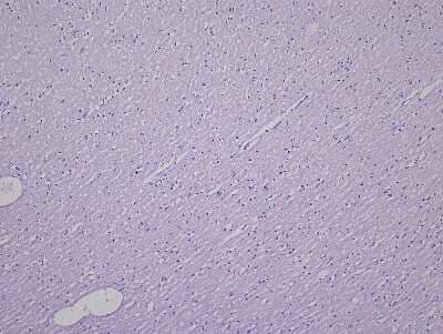 Hematoxylin & Eosin Stain: Brain Postcentral Gyrus Tissue Slides (Multiple Sclerosis) [NBP2-77994] - Tissue: Human Brain (Postcentral Gyrus),  Pathology: Multiple Sclerosis