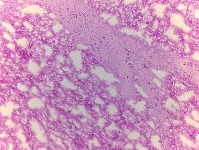 Hematoxylin & Eosin Stain: Brain Thalamus Tissue Slides (Alzheimer's) [NBP2-77608] - Tissue: Human Brain (Thalamus),  Pathology: Alzheimer's Disease