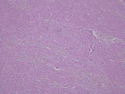 Hematoxylin & Eosin Stain: Brain Thalamus Tissue Slides (Alzheimer's) [NBP2-77834] - Tissue: Human Brain (Thalamus),  Pathology: Alzheimer's Disease