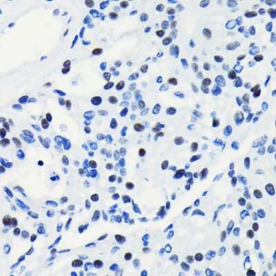 Immunohistochemistry-Paraffin: Brg1 Antibody (4N9C4) [NBP3-15773] - Immunohistochemistry of paraffin-embedded human oophoroma using Brg1 antibody (NBP3-15773) at dilution of 1:100 (40x lens).Perform microwave antigen retrieval with 10 mM PBS buffer pH 7.2 before commencing with IHC staining protocol.