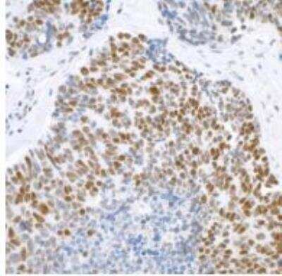 Immunohistochemistry-Paraffin: Brg1 Antibody (BLR106H) [NBP3-14696] - Antibody: Rabbit anti-BRG1 recombinant monoclonal antibody [BLR106H] Secondary: HRPconjugated goat anti-rabbit IgG.  Substrate: DAB.