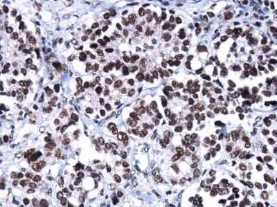 Immunohistochemistry-Paraffin: Brg1 Antibody (GT2712) [NBP3-13537] - Brg1 antibody [GT2712] detects Brg1 protein at nucleus in human oral carcinoma by immunohistochemical analysis. Sample: Paraffin-embedded human oral carcinoma. Brg1 antibody [GT2712] (NBP3-13537) diluted at 1:250. Antigen Retrieval: Citrate buffer, pH 6.0, 15 min