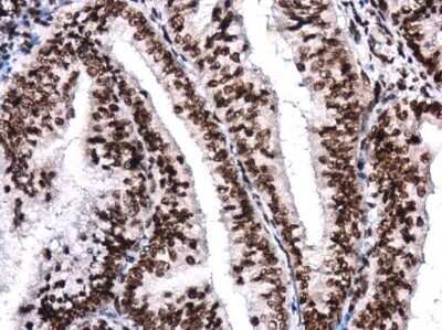 Immunohistochemistry-Paraffin: Brg1 Antibody (GT2712) [NBP3-13537] - Brg1 antibody [GT2712] detects Brg1 protein at nucleus in human endometrial carcinoma by immunohistochemical analysis. Sample: Paraffin-embedded human endometrial carcinoma. Brg1 antibody [GT2712] (NBP3-13537) diluted at 1:250. Antigen Retrieval: Citrate buffer, pH 6.0, 15 min