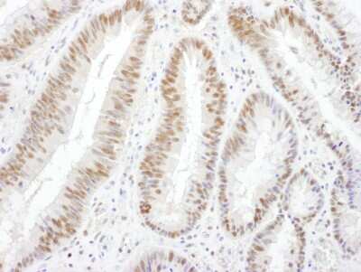 Immunohistochemistry: Brg1 Antibody [NBP2-22234] - Sample: FFPE section of human colon carcinoma. Antibody: Affinity purified rabbit anti- BRG1 used at a dilution of 1:1,000 (1ug/ml). Detection: DAB